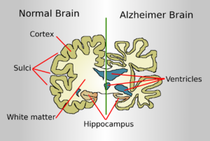 Beyond Amyloid — New Mechanisms in Alzheimer’s Disease Research